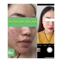 [NHẬP KHẨU] AcneDERM Kem Giảm Thâm Nám Và Ngăn Ngừa Mụn chứa 20% Azelaic 20g