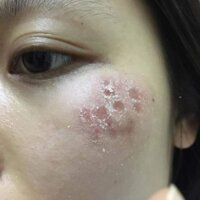 PEEL TCA USA CHẤM SEO THAM NAM DOI MOI