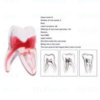 Răng cối lớn hàm trên có MB2 - Răng In Resin 3D