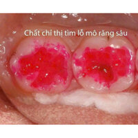 Redam gel đỏ chỉ thị, Nhuộm màu ngà sâu cho nha sĩ trám răng không bỏ sót