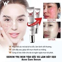 Serum Hỗ Trợ Làm Giảm Mụn ItS Well Plus Acne Care Serum 15ml