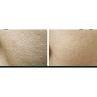 serum SE KHÍT LỖ CHÂN LÔNG
