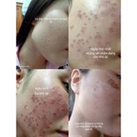 SÉT NHỎ PEEL TCA USA