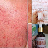 🍓🍓Sirrum dưỡng da bị giãn mao mạch 🍓🍓