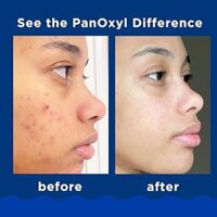 Sữa rửa mặt tạo bọt PanOxyl Benzoyl Peroxide 10% kháng khuẩn cường độ tối đa, 5,5 Oz | PanOxyl Acne Foaming Wash Benzoyl