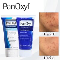 Sữa rửa mặt tạo bọt Panoxyl Acne 4%/PANOXYL Sữa rửa mặt 10% Benzoyl Peroxide Sữa rửa mặt cường độ tối đa