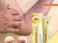 Tacrolimus 0.1% VCP 15g – Điều trị viêm da cơ địa, dị ứng da, chàm, vảy nến, eczema