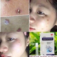 Tẩy sạch nốt ruồi Nga