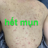 Thảo dược Khỏi sạch nhẵn nhụi mụn to, mụn nhỏ, lấm tấm mọc ở lưng, vai, gáy (Đông Y cổ truyền)