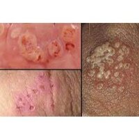 Thảo dược Khỏi sạch nhẵn nhụi ngứa ngáy lấm tấm đỏ, mụn rộp, mụn nước mọc ở đầu bao quy đầu (cổ truyền)