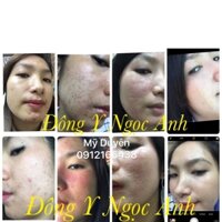 Thuốc đông y tri mụn