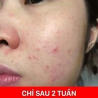 thuốc trị mụn dr.beauty