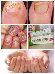 Thuốc Trị Nấm Da Móng Tay Clothasone D - Thái Lan