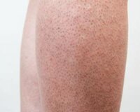 Thuốc Trị Viêm Lỗ Chân Lông Ở Chân Của Nhật: Giải Pháp Toàn Diện