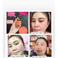 Tinh Chất Chấm Tàn nhang