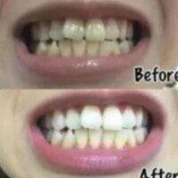 [TK5] Combo 14 miếng (7 gói/7 ngày) dán trắng răng Crest 3D White Whitestrips loại Professional Effects - Mỹ