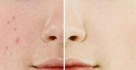 Top 10 sản phẩm trị thâm mụn hiệu quả nhanh, tốt nhất hiện nay