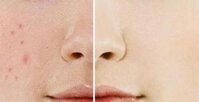 Top 10 sản phẩm trị thâm mụn hiệu quả nhanh, tốt nhất hiện nay