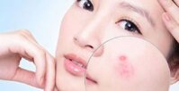 Top 20+ kem trị mụn bọc an toàn, hiệu quả nhanh, tốt nhất 2022