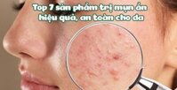 Top 7 sản phẩm trị mụn ẩn hiệu quả, an toàn cho da