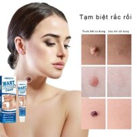 Trị mụn cóc kem loại bỏ mụn cóc 20g xóa nốt ruồi  mụn cóc mụn thịt  sạch mụn thịt thừa  mụn thịt, tàn nhang