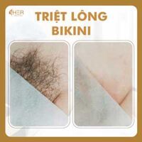 Triệt Lông Bikini (Bảo hành trọn đời)