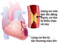 Trong Cơn Nhồi Máu Cơ Tim Cấp Dùng Thuốc Nào? Những Phương Pháp Điều Trị Cấp Cứu Thiết Yếu