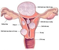 U Xơ Tử Cung Có Nên Uống Thuốc Tránh Thai? Hướng Dẫn Chi Tiết