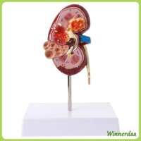 Winn Kích thước cuộc sống Mô hình bệnh thận của con người Giải phẫu Bệnh lý S