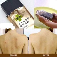 XÀ BÔNG ĐẶC NGỪA MỤN LƯNG FOR BACK