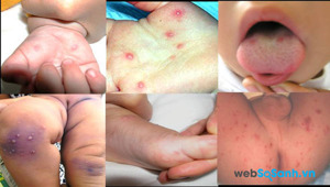 4 điều không thể bỏ qua khi bị sốt virus