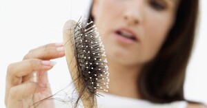 6 nguyên nhân hói đầu sớm và 4 giải pháp giúp tóc nhanh mọc trở lại
