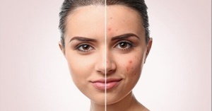 Bật mí cách lựa chọn kem dưỡng da trị mụn phù hợp