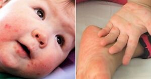 Bệnh chân tay miệng và mẹo dân gian chữa bệnh chân tay miệng nhanh hết