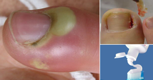 Bệnh chín mé và cách chữa bệnh hiệu quả mà đơn giản