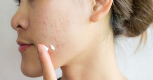 Bí quyết lựa chọn được những loại kem trị mụn tốt nhất hiện nay