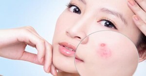 Hé lộ 3 dòng kem trị mụn trắng da hot nhất hiện nay