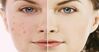 Khi dùng kem trị mụn thâm cần lưu ý những điều gì?