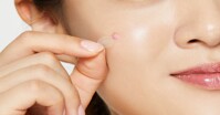 Miếng dán mụn có tác dụng gì? Cần lưu ý gì khi sử dụng?