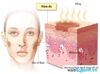Nguyên nhân và cách trị tận gốc nám da, tàn nhang