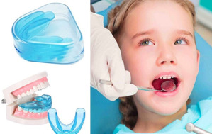 Niềng răng silicon có tốt không, chi phí, cách sử dụng, ưu nhược điểm?