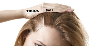 Sản phẩm thuốc mọc tóc tốt nhất hiện nay