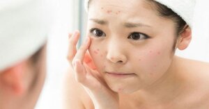Serum trị mụn nào tốt, giá rẻ mà lành tính ai cũng dùng được
