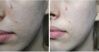 Tẩy tế bào chết cho da mụn: nên hay không nên?