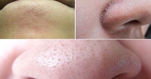 Top 4 kem trị mụn cám mang lại hiệu quả đang được các chị em tin dùng