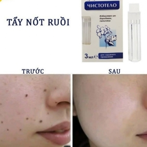 Gel tẩy nốt ruồi, mụn thịt, thịt thừa Dvelinil