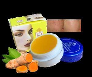 Kem nghệ trị mụn thâm Q’Care White