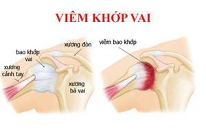 Viêm Quanh Khớp Vai - Chẩn Đoán Và Điều Trị